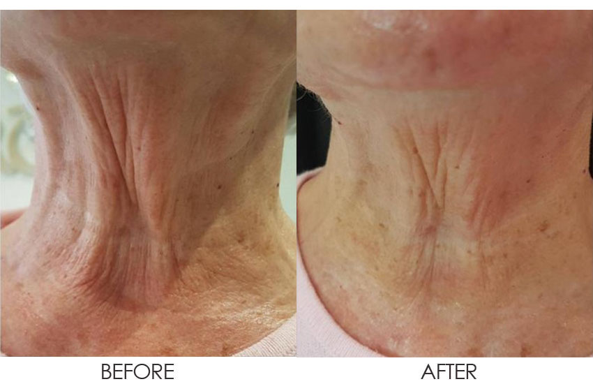 Fibroblast-before-and-after-1