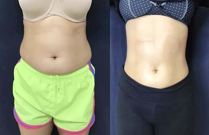 PhysiQ-before-and-after_01