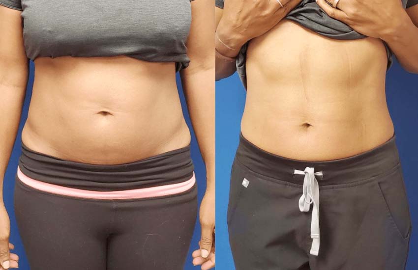 PhysiQ-before-and-after_02