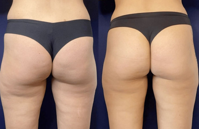 PhysiQ-before-and-after_03