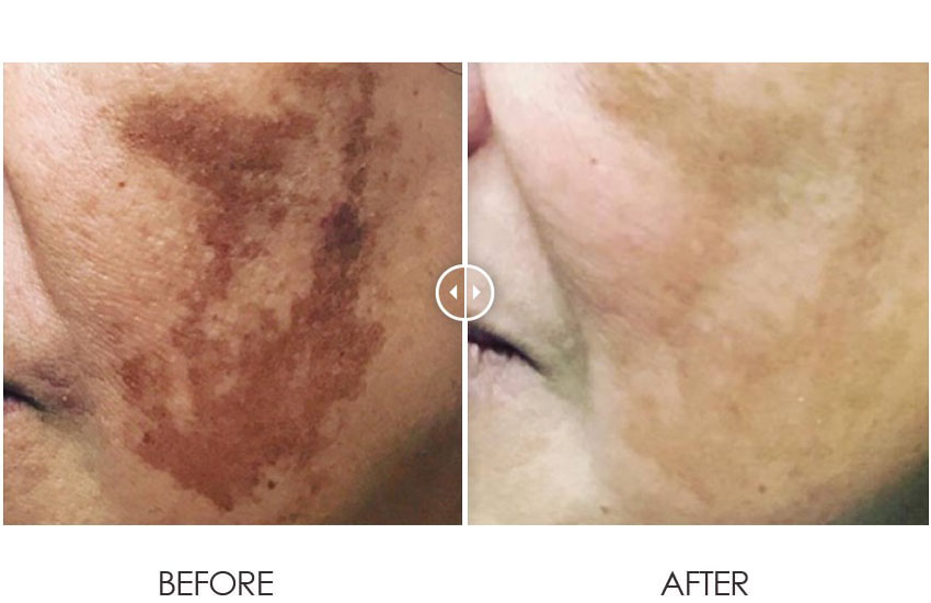 PicoLazer_beforeafter_01-web