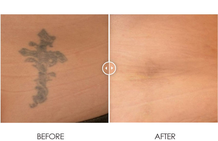 PicoLazer_beforeafter_03-web