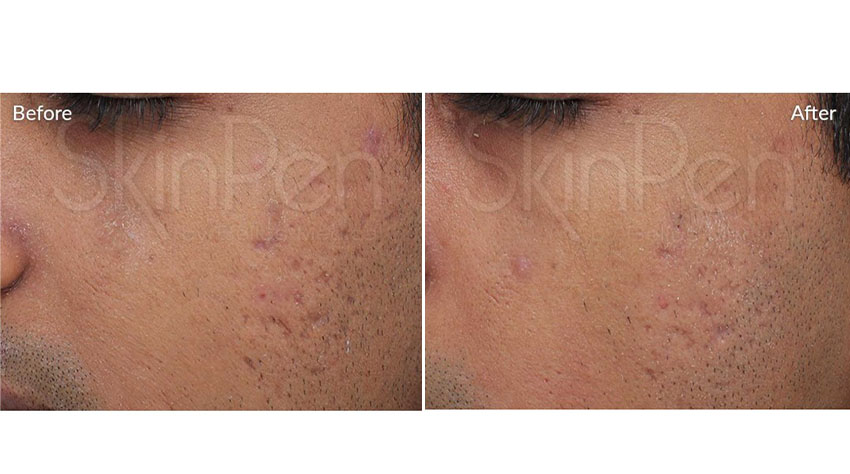 SkinPen_beforeafter_01-web