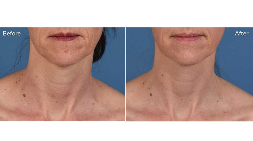 SkinPen_beforeafter_04-web